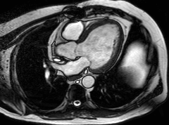 Μαγνητική Τομογραφία Καρδιάς - Heart MRI